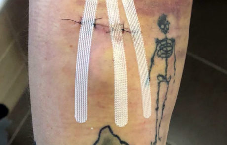 Kaputter Arm